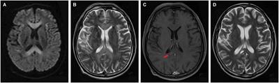 Gadolinium Enhancement May Indicate a Condition at Risk of Developing Necrosis in Marchiafava–Bignami Disease: A Case Report and Literature Review